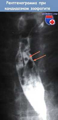 Рентгенограмма при кандидозном эзофагите