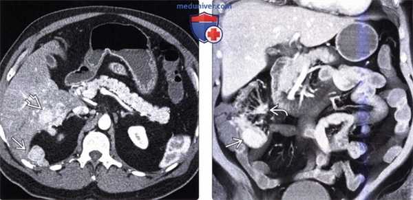 Рентгенограмма, КТ, МРТ при карциноиде (карциноидной опухоли) желудочно-кишечного тракта