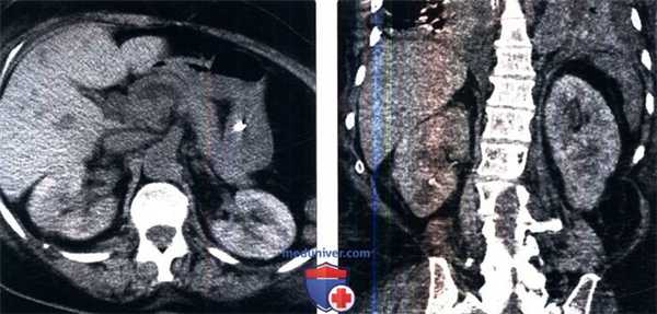 Рентгенограмма, КТ при контраст-индуцированной нефропатии