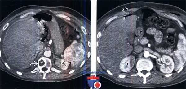 КТ при радиационном нефрите