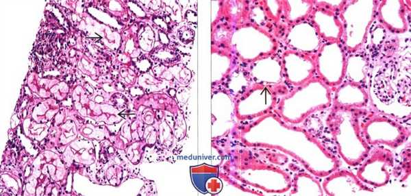 Рентгенограмма, КТ при контраст-индуцированной нефропатии
