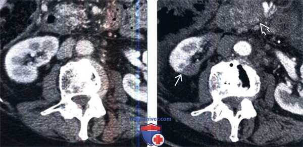 КТ при радиационном нефрите