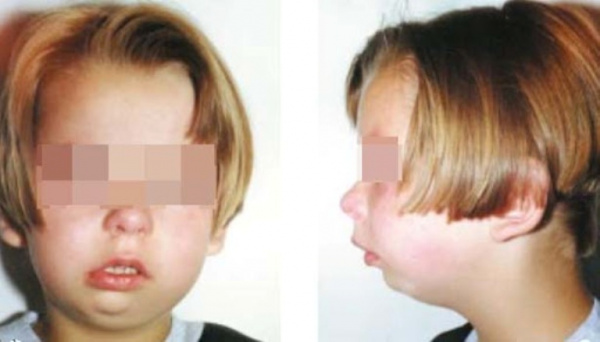 Анкилоз ВНЧС