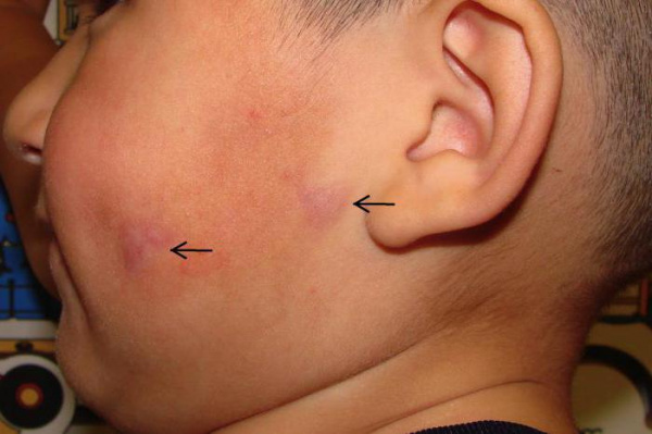 Кожные проявления эозинофильной гранулемы