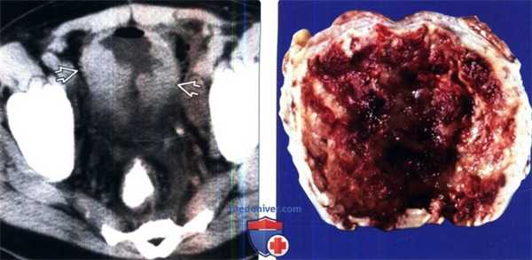 Рентгенограмма, КТ при малокоплакии