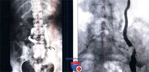 Ретроградная пиелография при стриктуре мочеточника