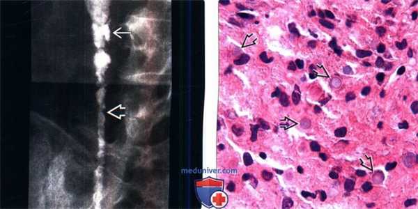 Рентгенограмма, КТ при малокоплакии