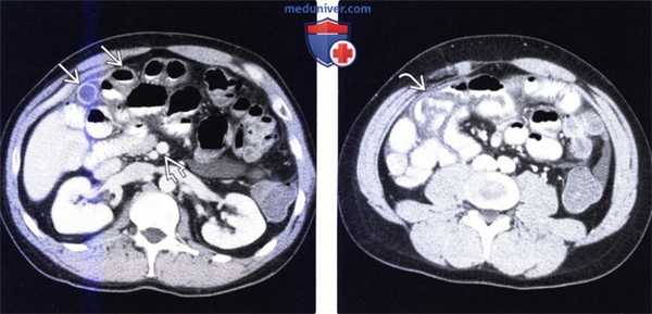 Лучевая диагностика мальротации кишечника