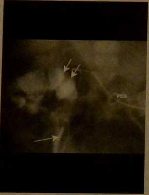 Снимки МРТ и КТ. Мальротация с заворотом кишки