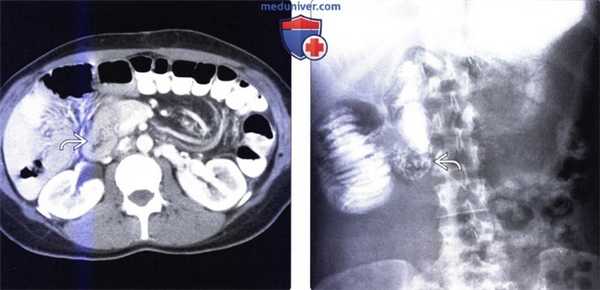 Лучевая диагностика мальротации кишечника