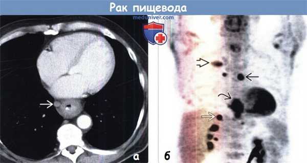Рак пищевода на КТ и ПЭТ