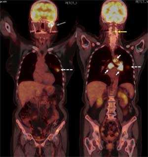 На позитронно-эмиссионной компьютерной томограмме виден первичный очаг раковой опухоли в левом лёгком (показан белой пунктирной стрелкой), трахеобронхиальные узлы и узлы в воротах лёгких (показаны сплошными белыми линиями), грудной паравертебральный метастаз (показан жёлтой стрелкой) и метастаз в мыщелок нижней челюсти слева (показа сероё стрелкой).