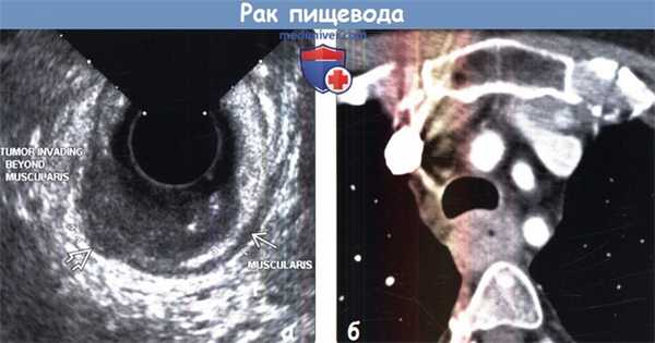 Рак пищевода на УЗИ и КТ