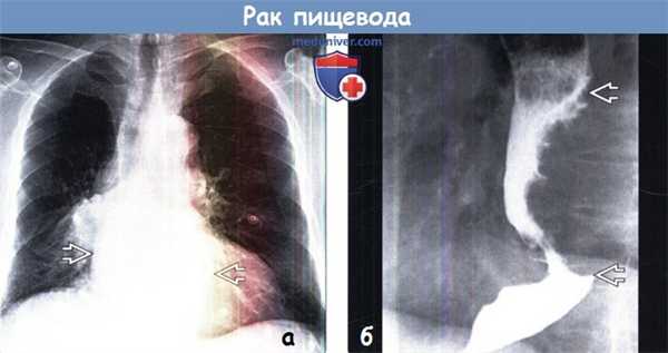 Рак пищевода на рентгенограмме