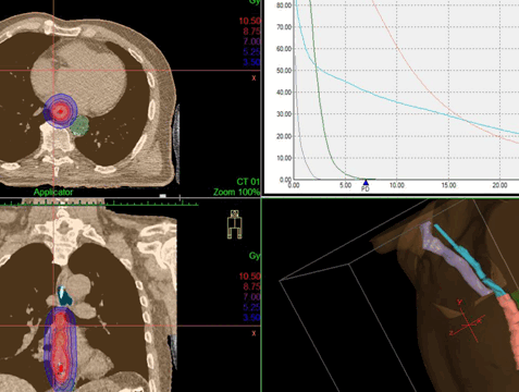 Дозное распределение, получаемое при дистанционной конформной лучевой терапии и внутрипросветной брахитерапии