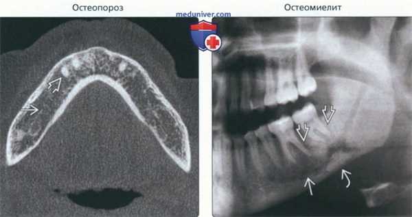 Рентгенограмма, КТ при изменениях твердой пластинки зуба челюсти