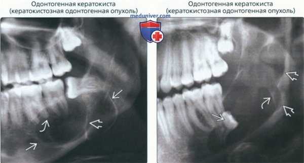 Рентгенограмма, КТ при многокамерном просветлении челюсти