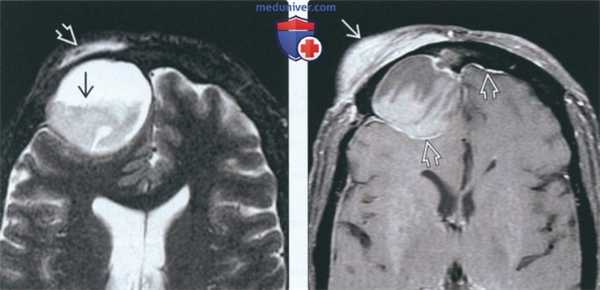 КТ, МРТ при мукоцеле носа и околоносовых пазух