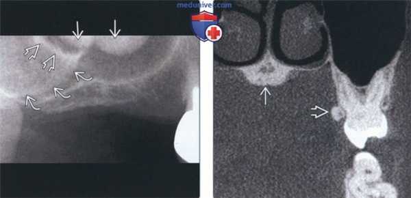 Лучевая диагностика небного валика