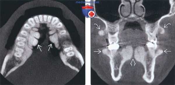 Лучевая диагностика нижнечелюстного валика