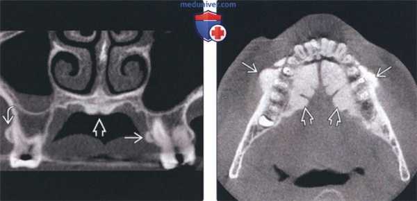 Лучевая диагностика щечных и небных экзостозов челюсти