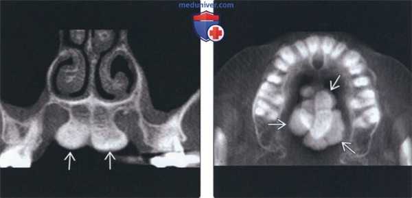 Лучевая диагностика небного валика