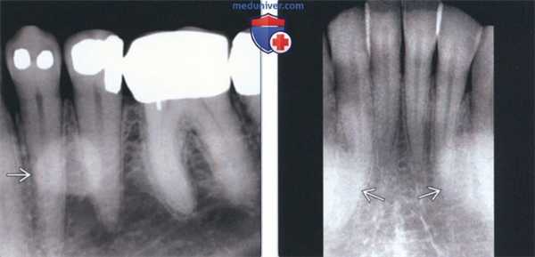Лучевая диагностика нижнечелюстного валика