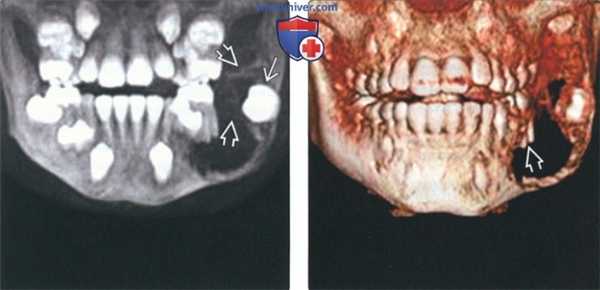 Рентгенограмма, КТ при амелобластической фиброме челюсти