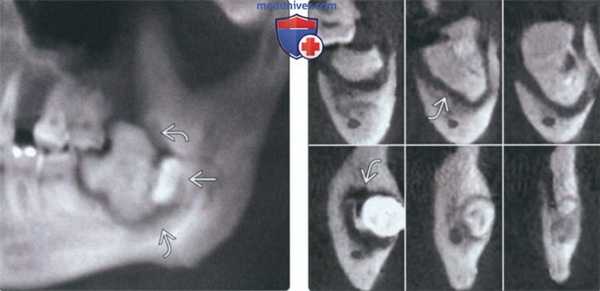 Рентгенограмма, КТ при одонтоме челюсти