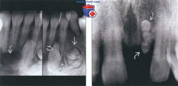 Рентгенограмма, КТ при одонтоме челюсти