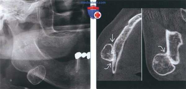 Лучевая диагностика остеомы челюсти