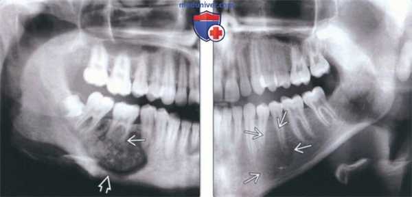 Лучевая диагностика остеобластомы челюсти