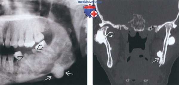 Лучевая диагностика остеомы челюсти