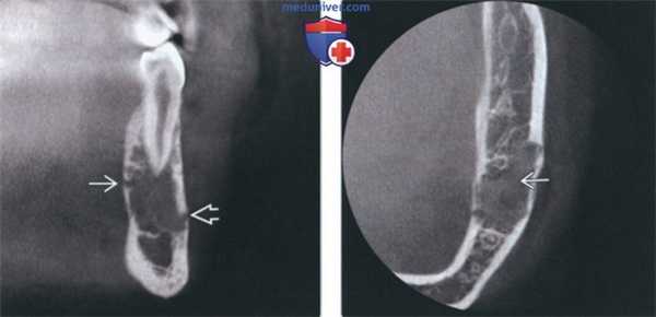 Лучевая диагностика остеобластомы челюсти