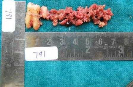 Агрессивная остеобластома нижней челюсти: диагностические сложности