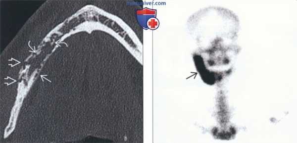Рентгенограмма, КТ при остеомиелите челюсти