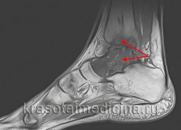 Остеомиелит челюсти