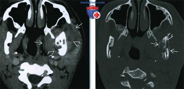 Остеомиелит верхней челюсти и нижней челюсти - лучевая диагностика