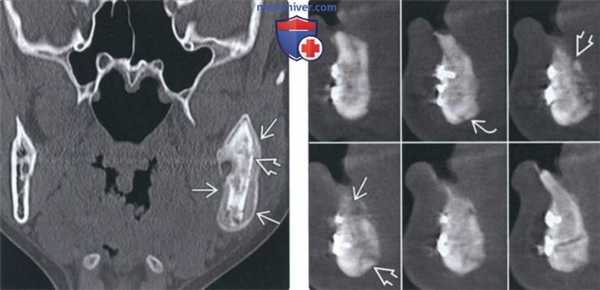 Рентгенограмма, КТ при остеомиелите челюсти