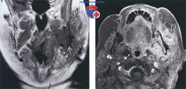Рентгенограмма, КТ при остеомиелите челюсти