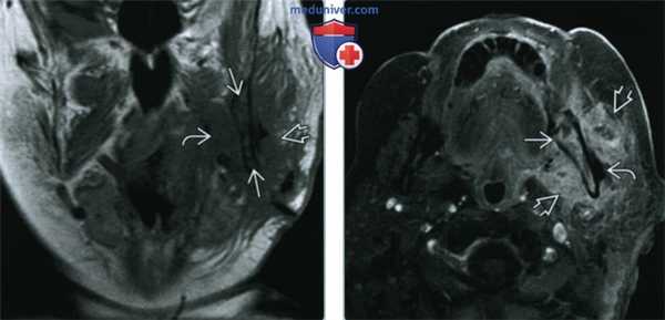 Остеомиелит верхней челюсти и нижней челюсти - лучевая диагностика