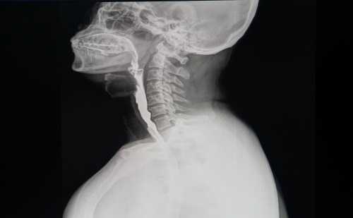 Снимок пищевода