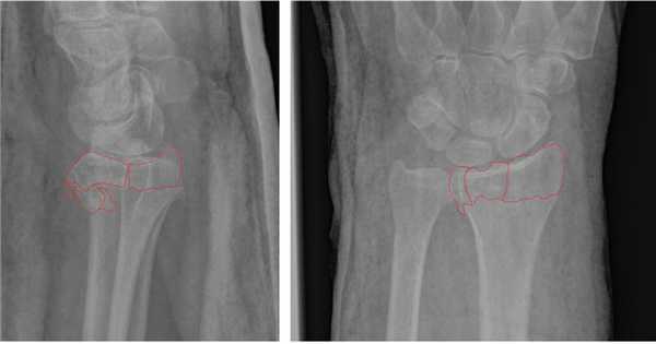 перелом луча в типичном месте