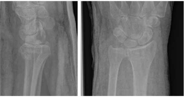 внутрисуставной перелом дистального метаэпифиза лучевой кости