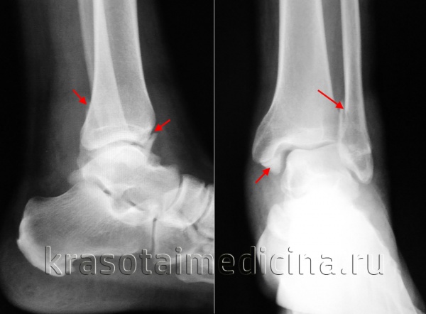 Перелом лодыжек