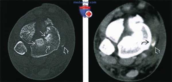 Рентгенограмма, КТ, МРТ при переломе дистального метаэпифиза большеберцовой кости