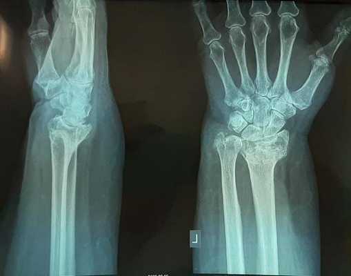 перелом луча лечение в гипсе