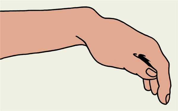 деформация лучезапястного сустава