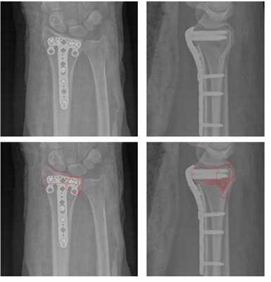 операция при переломе лучевой кости