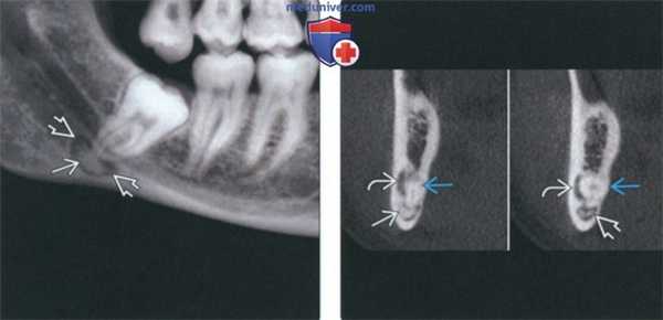 Рентгенограмма, КТ при периапикальной костной дисплазии